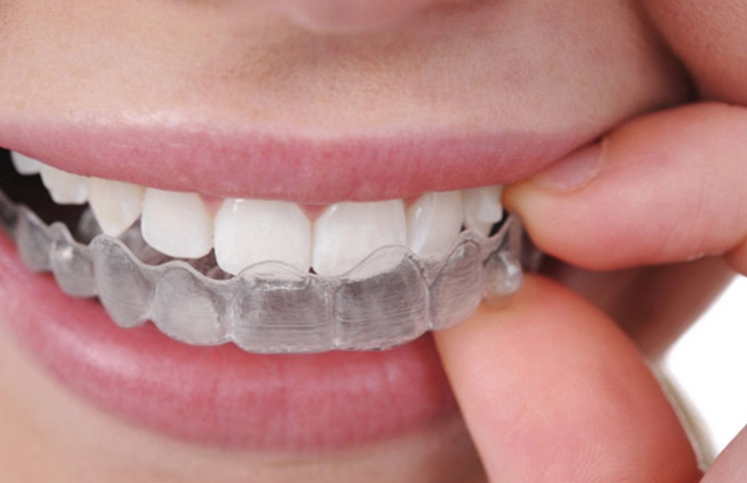 invisalign